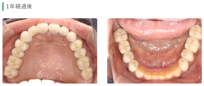 セラミック治療症例紹介